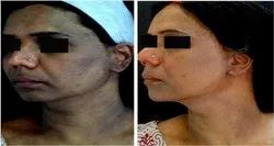 Acane Peel Treatment in chennai