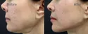 Filler Treatment For Jawline Correction